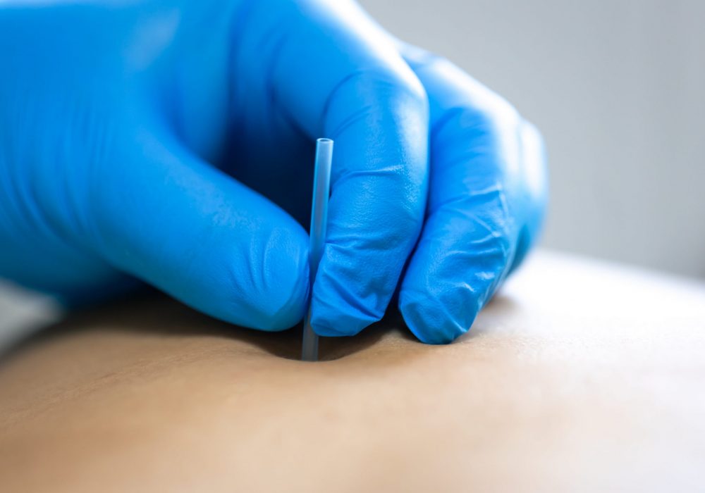 Punción Seca Santa Pola