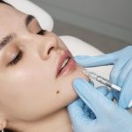 Aumento labios Santa Pola medicina estética santa pola